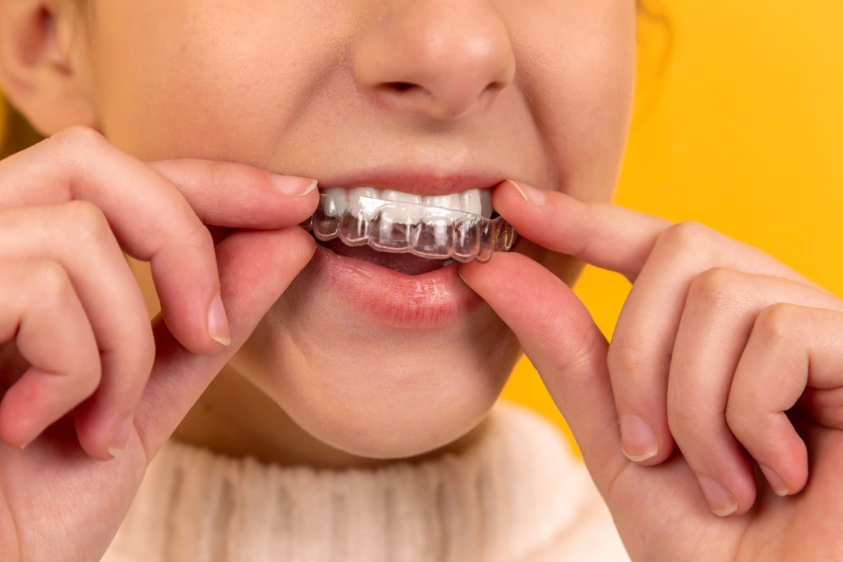 Ortodoncia con alineadores transparentes - Smile Clinica Dental