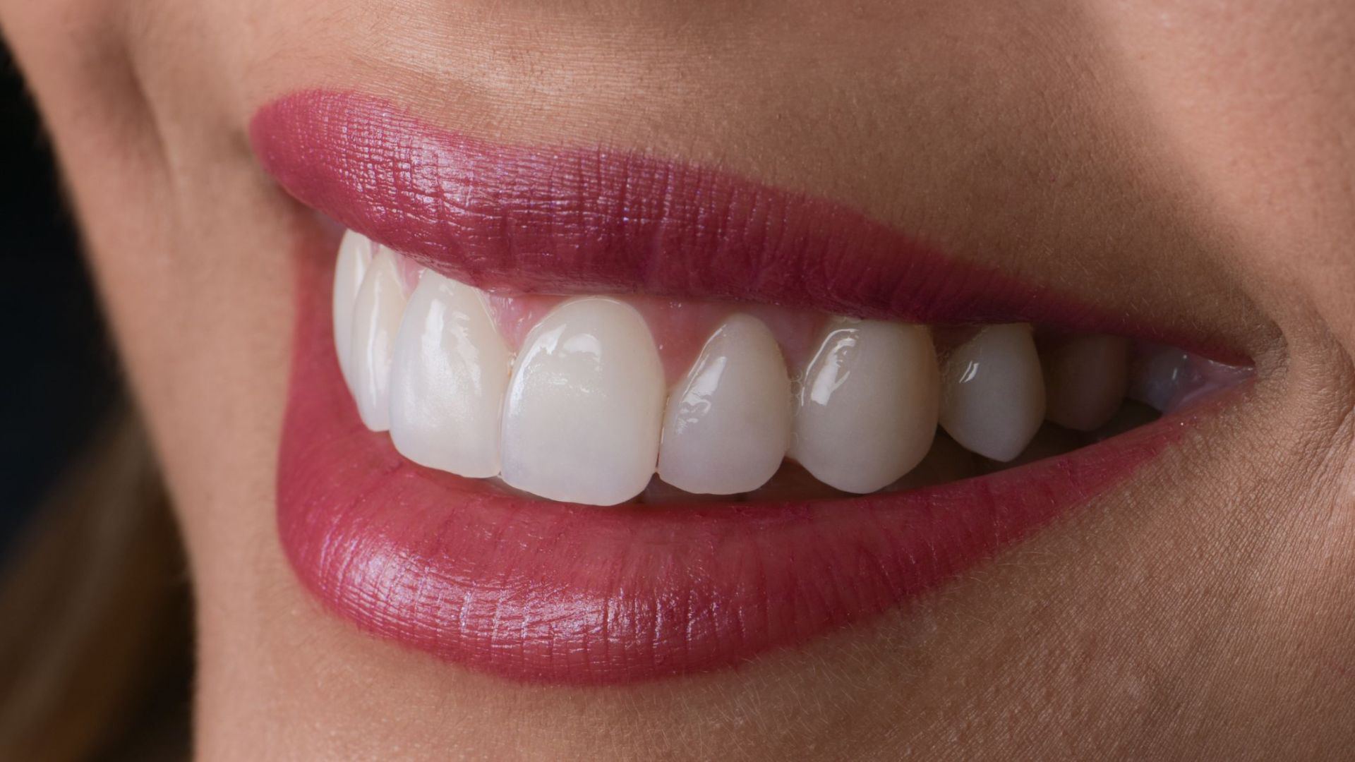 Diseno de sonrisa - Smile Clinica Dental