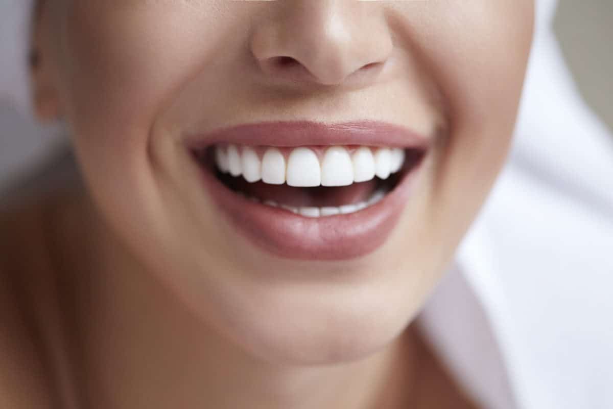 Carillas dentales de porcelana - Smile Clinica Dental